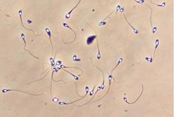 Оценка морфологии сперматозоидов (по Крюгеру) | Балтийский институт репродуктологии человека (БИРЧ)