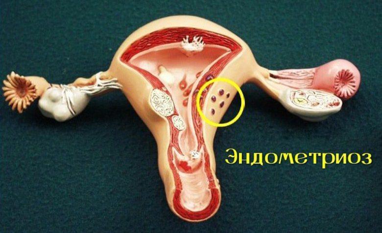 Болезнь «эндометриоз»: каковы симтомы?