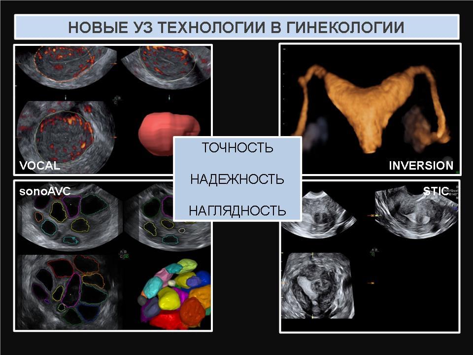 Опухоли яичников: лечение, причины, профилактика