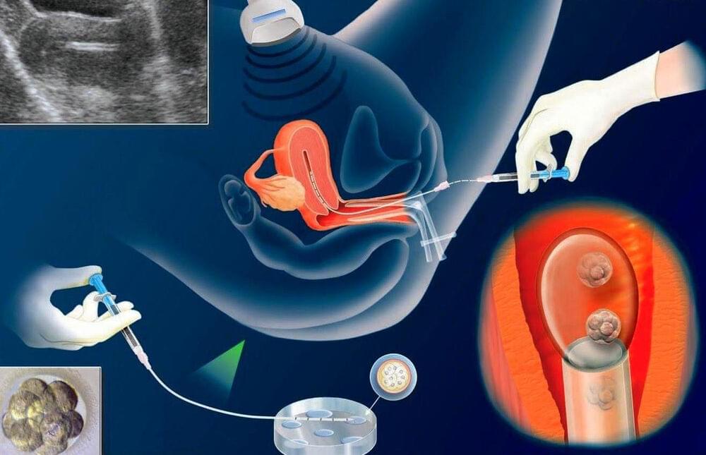 ЭКО-подсадка эмбрионов: особенности проведения, назначение