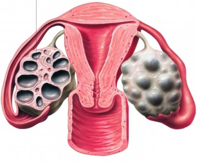 Синдром поликистозных яичников или мультифолликулярные яичники